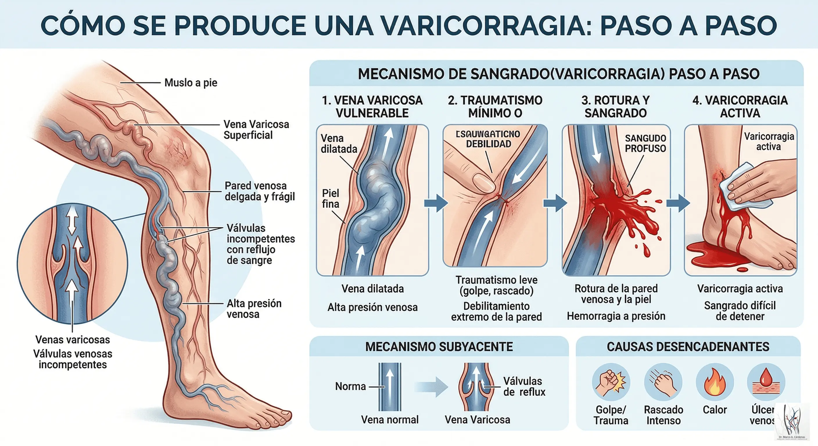 Varicorragia